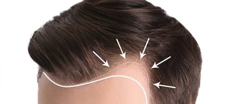 السياحة العلاجية لزراعة الشعر في تركيا