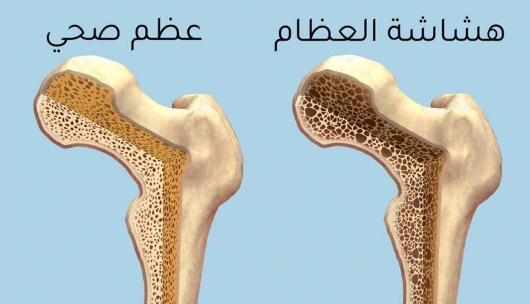 تعرف على كيفية الوقاية من هشاشة العظام - وكيفية الاستفادة من السياحة العلاجية